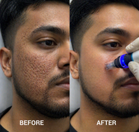 Microneedling RF